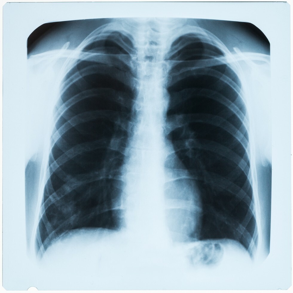 Chest X-ray